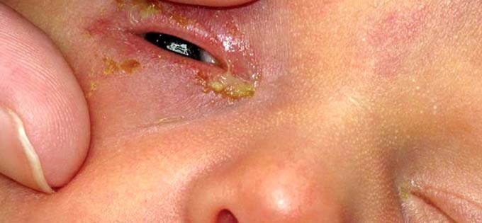 острый конъюнктивит у детей