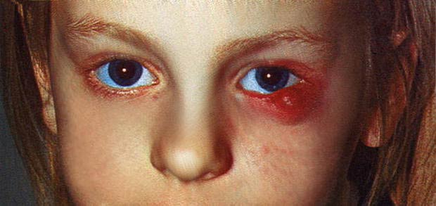 лечение абсцесса век