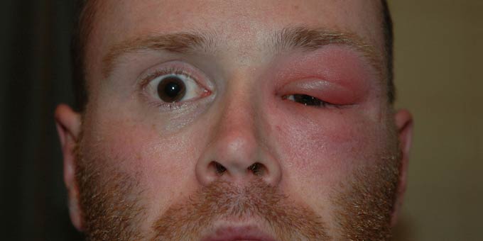 абсцесс глазницы