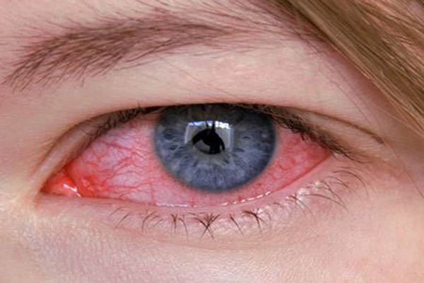 лечение аденовирусного конъюнктивита