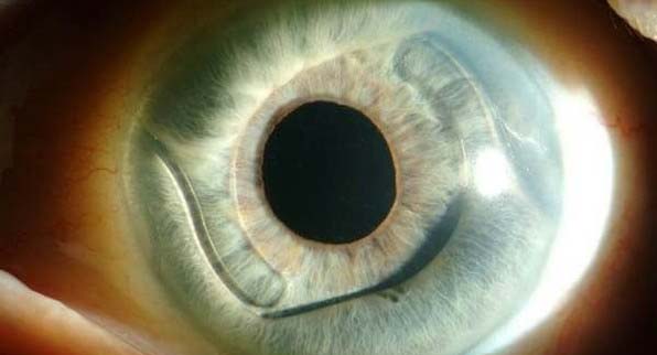 стадии афакии