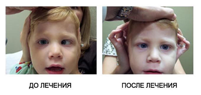 лечение амблиопии