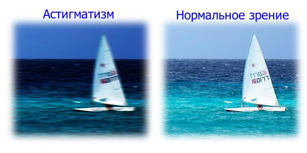 причины возникновения астигматизма