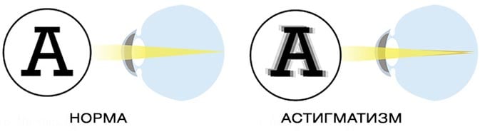 норма и астигматизм