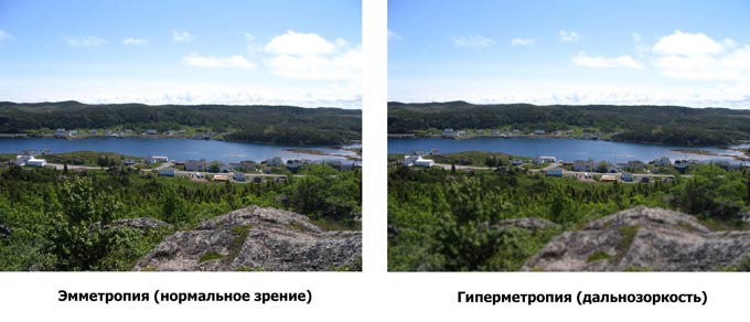 гиперметропия высокой степени с астигматизмом