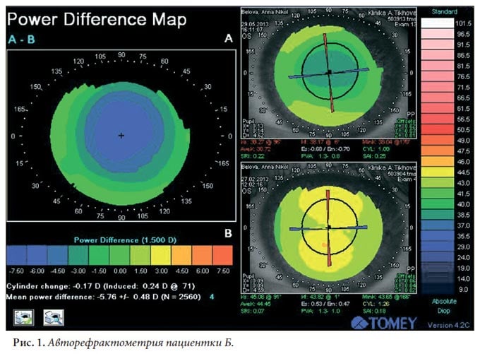 расшифровка авторефрактометрии