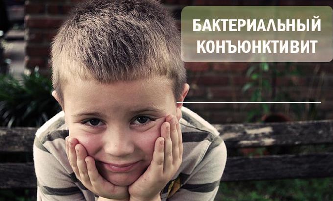 заразен ли конъюнктивит