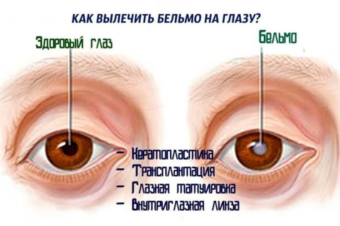 способы лечения бельма