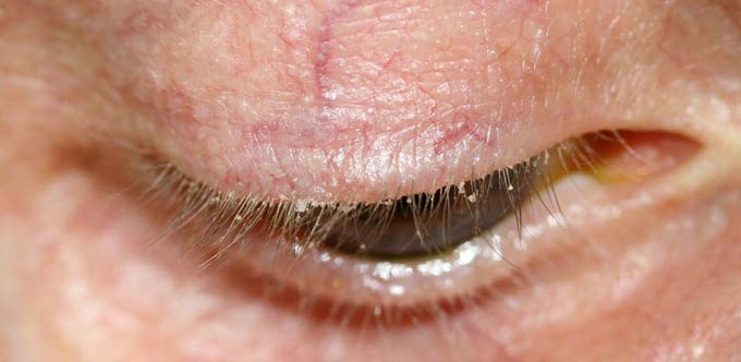 чешуйчатый блефарит