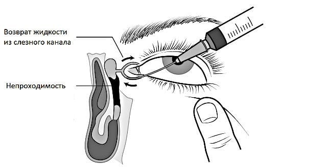 бужирование слезного канала у новорожденных