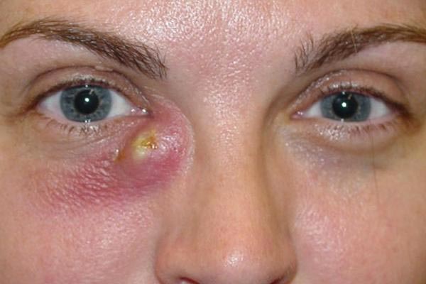 бужирование слезного канала у взрослых