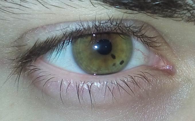 на зрачке появилась черная точка