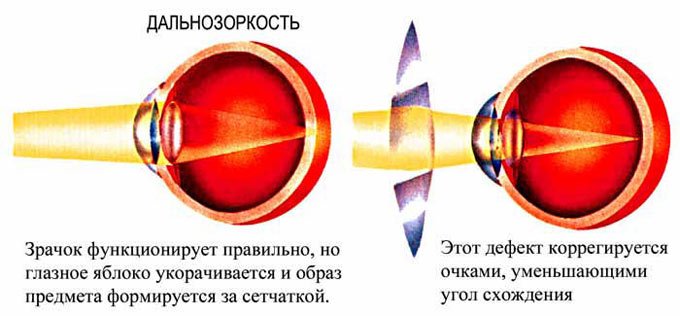 строение глаза при дальнозоркости