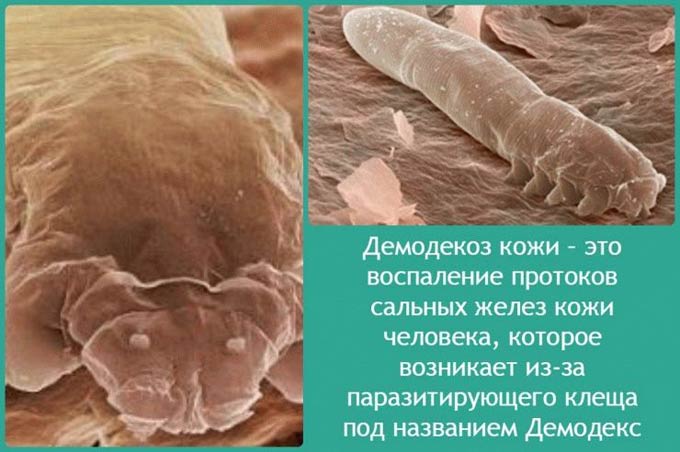 демодекоз век