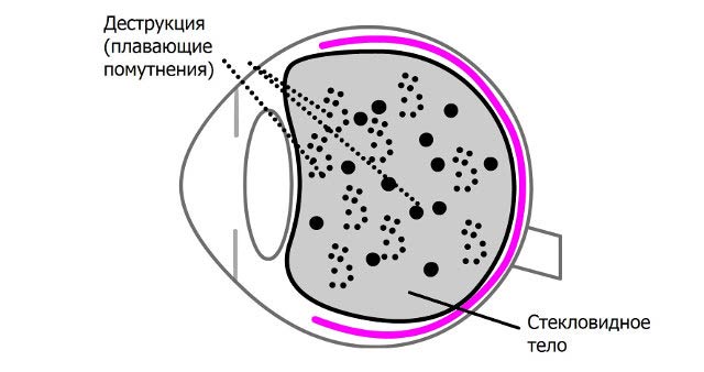 плавающие помутнения