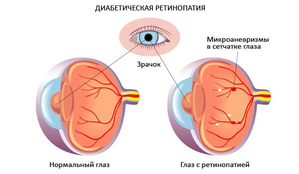 лечение ретинопатии при сахарном диабете