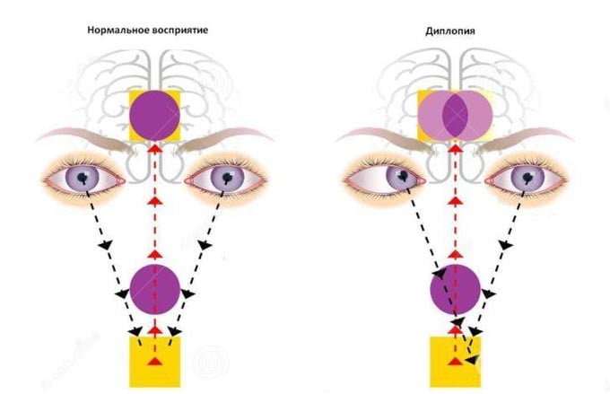 зрение при диплопии