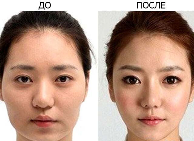 эпикантус до и после