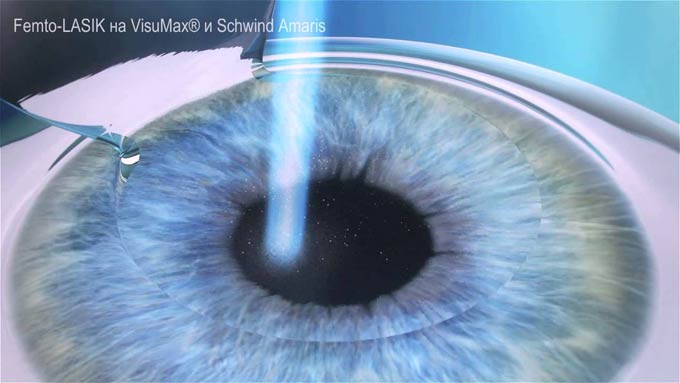 femto lasik