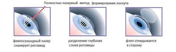 фемтосекундный лазер