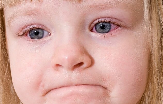 фолликулярный конъюнктивит у детей