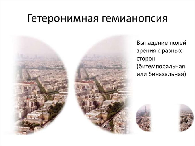гетеронимная гемианопсия