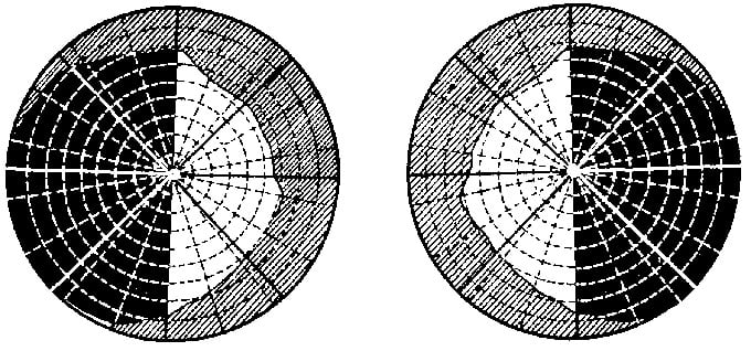 гомонимная гемианопсия