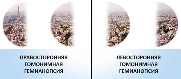 правосторонняя и левосторонняя гемианопсия