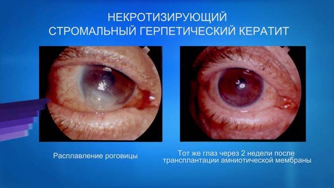 метагерпетический кератит