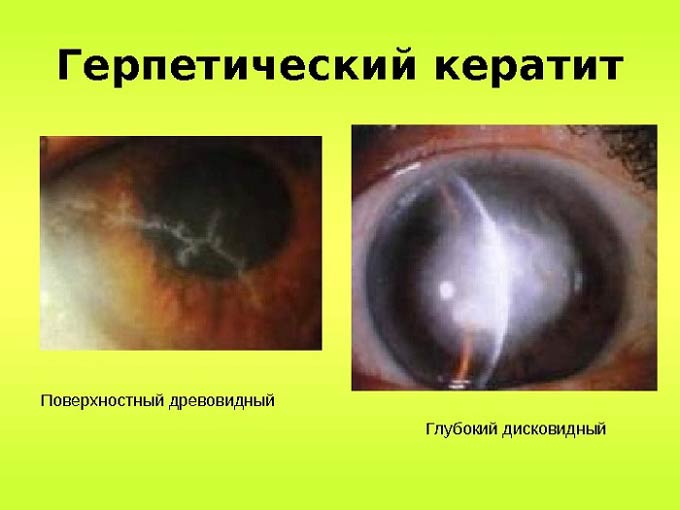 древовидный герпетический кератит