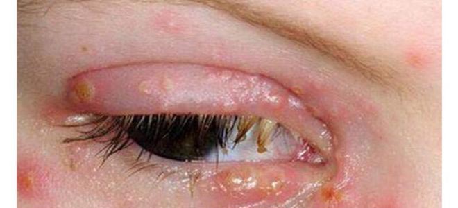 лечение герпетического конъюнктивита