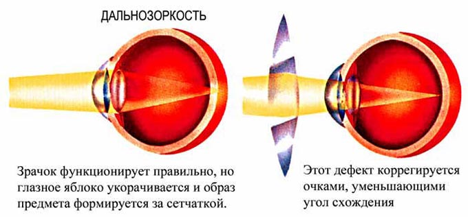 гиперметропия слабой степени