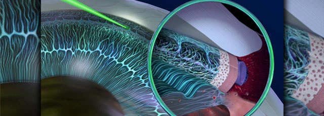 подготовка к лазерной операции при глаукоме