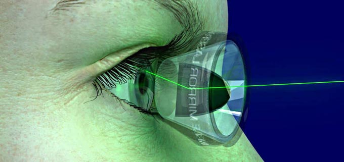 Лазерная трабекулопластика