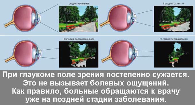 стадии глаукомы