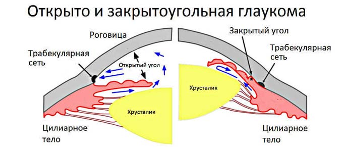 схема видов глаукомы
