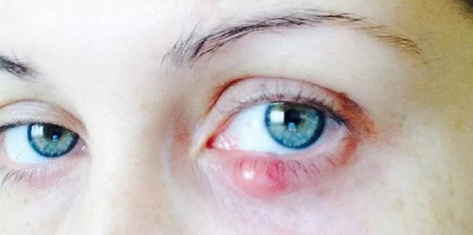 халязион нижнего века