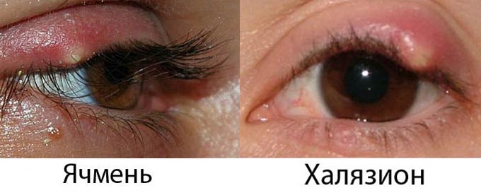 ячмень и халязион
