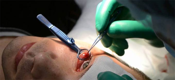 как удаляют халязион верхнего века