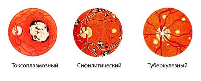 виды хориоретинита