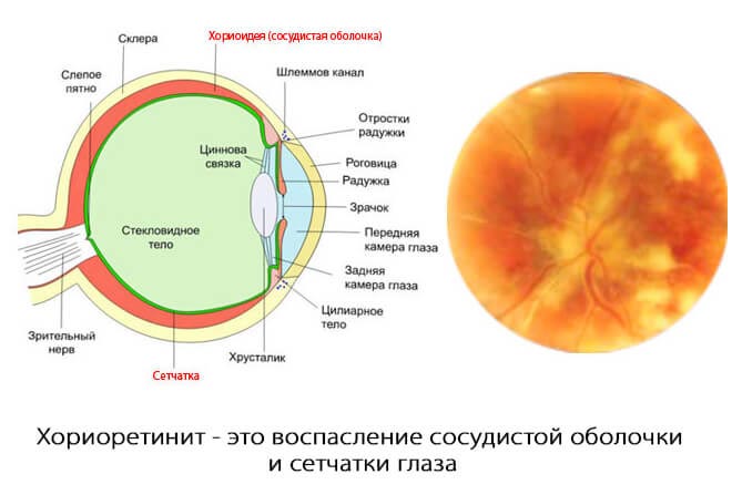 центральный хориоретинит
