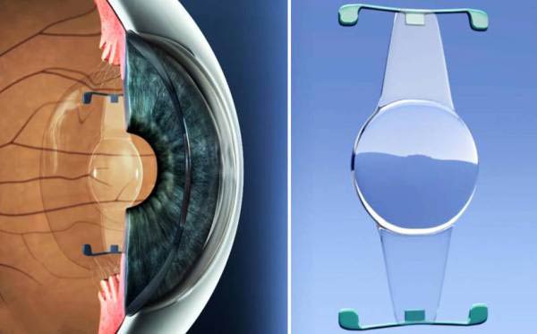 материал для интраокулярных линз