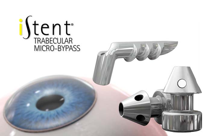 iStent метод лечения глаукомы