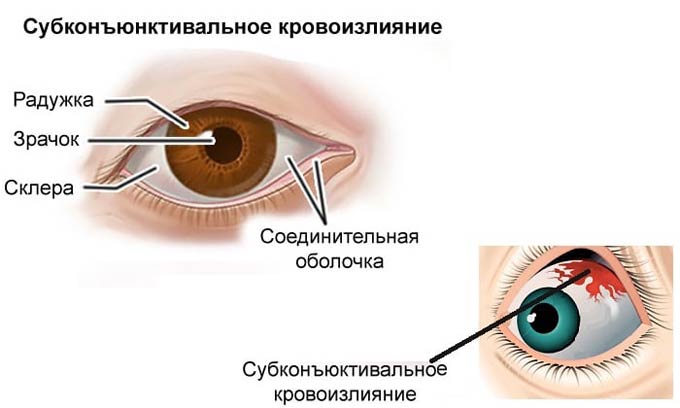 субконъюнктивальное кровоизлияние