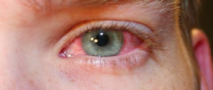 резь в глазу