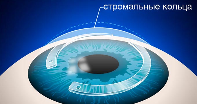 стромальные кольца