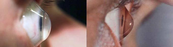 лечение кератоконуса народными средствами