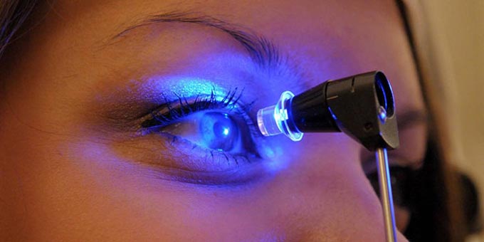 стадии кератоконуса