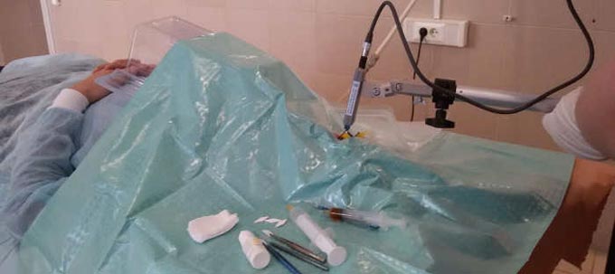 трансплантация роговицы