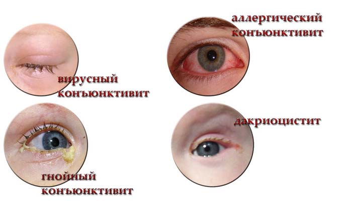 виды конъюнктивита